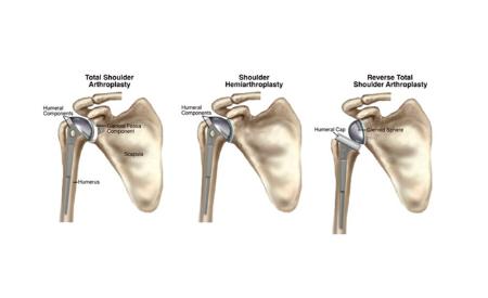 Imagen Simulación biomecánica de la articulación del hombro para el estudio de...